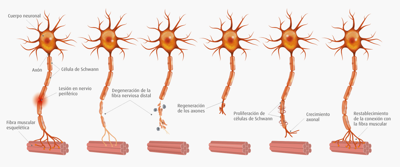Recuperación neuropatía
