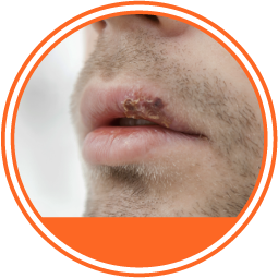 Herpes círculo