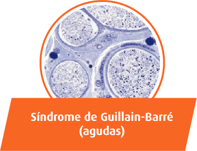 Síndrome de Guillain-Barré