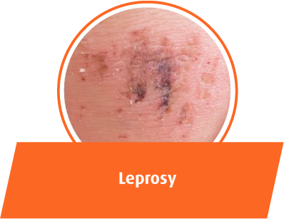 Leprosy