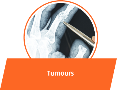 Tumours